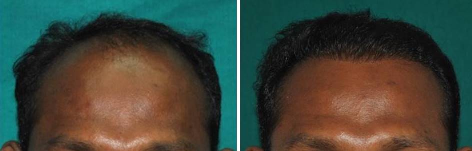 Hair transplant result in India